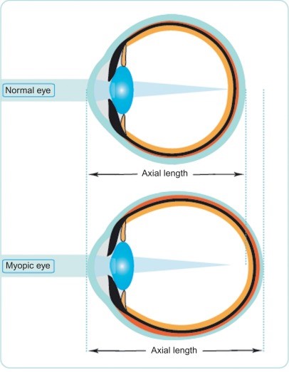 myopia progression and myopia forecast